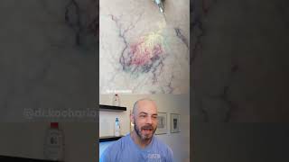 Doctor reacts to satisfying sclerotherapy treatment dermreacts sclerotherapy [upl. by Corilla]