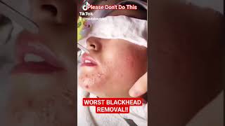 ❌ Worst BLACKHEAD REMOVAL Technique shorts [upl. by Eenaffit]