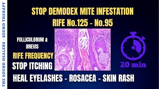 DEMODEX ➤ Stop Itching ➤ Mite Infestation ➤ Heal Eyelashes ➤ Dermatitis ➤ Skin Rash ➤ Sound Therapy [upl. by Tillion]