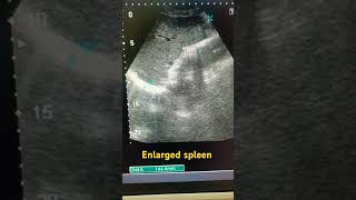 Spleen siz splenomegaly ultrasound ytviral medical study spleen shortfeed shortviral abdomen [upl. by Arretak]