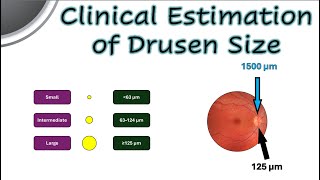 Clinical Estimation of Drusen Size [upl. by Marek346]