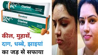 Himalaya Clarina Antiacne Cream Review  Kaise use kare  Results  Acne Removal Cream [upl. by Inavoj]