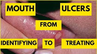 Mastering Recurrent Aphthous Stomatitis Most Common Mouth Ulcers and Effective Treatment Strategies [upl. by Nirik]