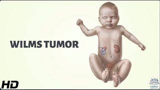 Wilms Tumor Everything You Need To Know [upl. by Arrekahs932]