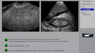 Ultrasound of the Liver HCC 1 in Arabic أورام الكبد [upl. by Ladnar267]