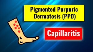 Pigmented purpuric dermatosis Capillaritis overview clinical features histology and management [upl. by Boykins712]