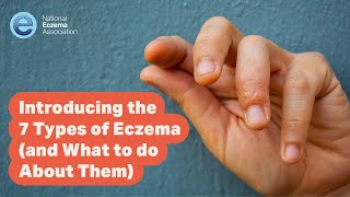 Introducing the 7 Types of Eczema and What to do About Them [upl. by Dnamron39]