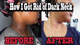 How to get rid of dark neck Lightening amp brightening hyperpigmentation on my neck [upl. by Blanche373]