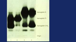 Hemoglobinopathies part 2 [upl. by Alet625]