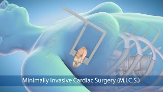 Medical Animation Minimally Invasive Cardiac Surgery MICS at Sarasota Memorial Hospital [upl. by Rodman]