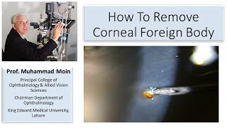 How to Remove Corneal Foreign Body [upl. by Noned]