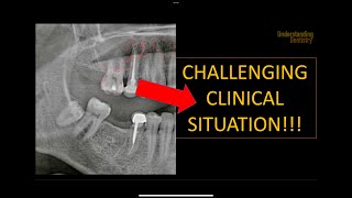 How to solve this clinical case OPG interpretation radiology radiographic interpretation x ray [upl. by Leahpar]