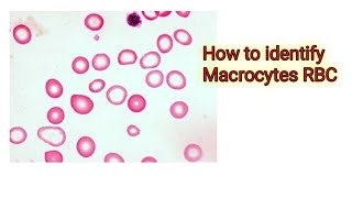 Macrocytes RBC [upl. by Ninnetta246]