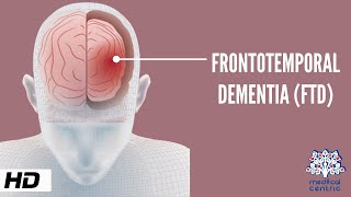 Frontotemporal Dementia Causes Signs and Symptoms Diagnosis and Treatment [upl. by Wylma]