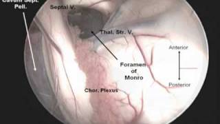 Endoscopic Third Ventriculostomy [upl. by Llednil]