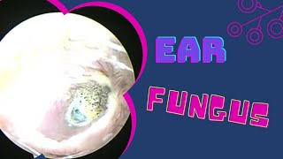 FUNGAL INFECTION EAR OTOMYCOSIS [upl. by Susan759]