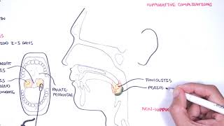 Strep throat streptococcal pharyngitis pathophysciology signs and symptoms diagnosis treatment [upl. by Julita]