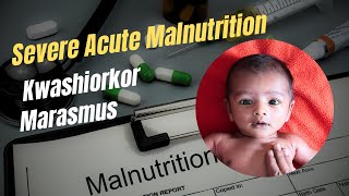 Severe Acute Malnutrition Kwashiorkor Marasmus Protein Energy Malnutrition Robbins Chapter 8 [upl. by Gord]