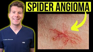 Doctor explains SPIDER ANGIOMA aka spider nevustelangiectasia  Causes photos treatments [upl. by Eicyak]