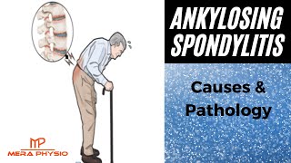 Ankylosing Spondylitis  Back Pain  Causes amp Pathology  In Hindi  Mera Physio [upl. by Aicekan]