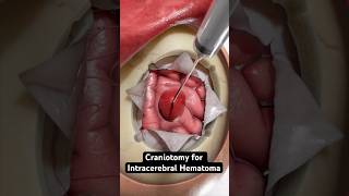 Removing pooled blood from the brain 3D Animation [upl. by Jarin]