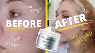 Neutrogena Rapid Wrinkle Repair Review not sponsored  Retinol for Acne  3 month progress [upl. by Narat]