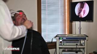 Nasal Endoscopy Informational Video by Ohio Sinus Institute [upl. by Airdnaxila]