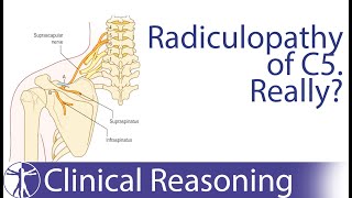 Suprascapular Nerve Entrapment mimicking C5 Radiculopathy [upl. by Iahs603]