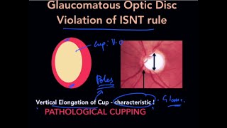 High Yield Topic  Optic Disc Changes in Glaucoma  The Complete Course [upl. by Ellenrahc585]