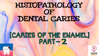 HISTOPATHOLOGY OF DENTAL CARIES  CARIES IN THE ENAMEL PART2 [upl. by Quartus459]