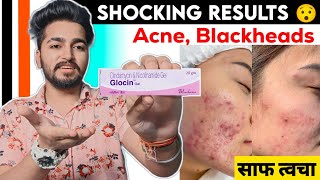 Glocin Gel Review  Best Cream For Acne Pimples Blackheads [upl. by Meri55]