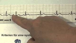 EKG für Pflege Teil 13  atemabhängige Sinusarrhythmie interpretieren [upl. by Anerda]