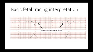 Interpreting Intrapartal fetal heart rate tracings [upl. by Gonagle792]