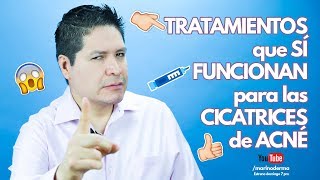 TRATAMIENTOS QUE SÍ FUNCIONAN EN CICATRICES DE ACNÉ [upl. by Eilrahc]