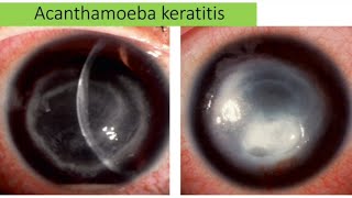 Acanthamoeba keratitis  causes sign clinical pictures management [upl. by Svoboda]