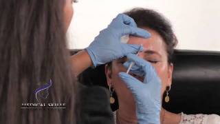 Botulinum Toxin  Injection Technique [upl. by Nagah479]