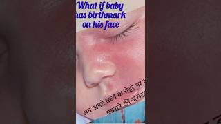 Birthmark on face  No need to worry 😊awarenessbabycare trendingvideo pediatrics baby [upl. by Inavoj]