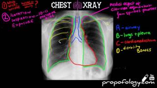 LEARN to Read a Chest Xray in 5 minutes [upl. by Annaert]