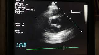 The patient with severe AR and aortic aneurysm [upl. by Adnomal629]