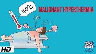 MALIGNANT HYPERTHERMIA Causes Signs and Symptoms Diagnosis and Treatment [upl. by Ahsimet]