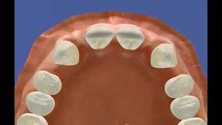 Missing lateral incisors due to decay [upl. by Niliac]