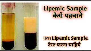 Lipemic blood sample  Lipemic  Lipemic serum [upl. by Llednav]