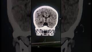 Corpus Callosum Agenesis  Radiology [upl. by Susy]