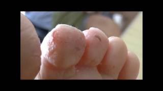 severe case of Athletes Foot before and 6 days after starting treatment [upl. by Acihsay]