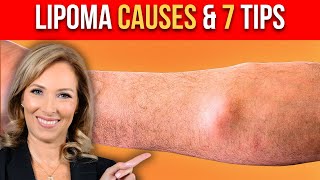 Lipoma Causes  7 Tips to Get Rid of Them  Dr Janine [upl. by Aniluj348]