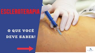 Escleroterapia PONTOS POSITIVOS E NEGATIVOS O QUE VOCÊ PRECISA SABER [upl. by Emogene]