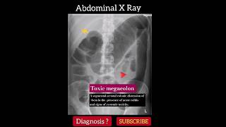 Toxic megacolon  Diagnosis   Abdominal X Ray  Radiology [upl. by Latisha]