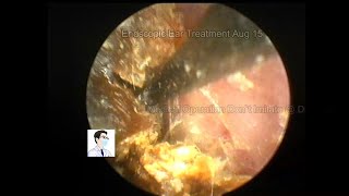 103 years old patient ear wax removal [upl. by Stila353]