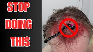 Stop Microneedling WATCH NOW [upl. by Eintirb]