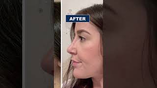 Rhinoplasty Before and After  Nose Job in Turkey  Rhinoplasty Surgeon [upl. by Onitsuj]